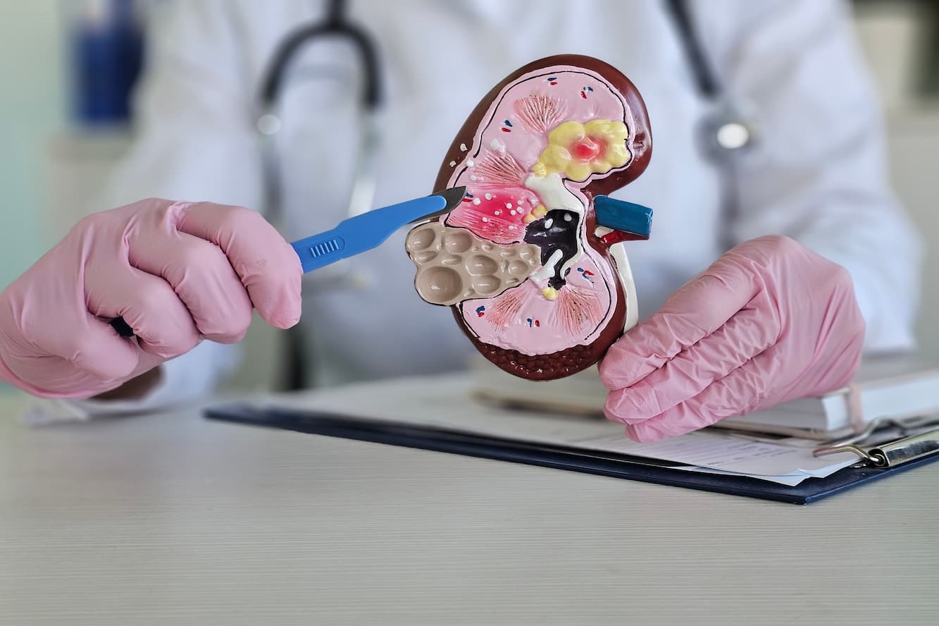 lithotripsy