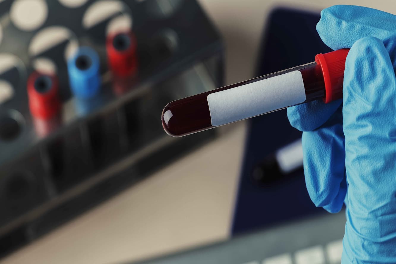 Stem Cell Transplantation - Medvoyage
