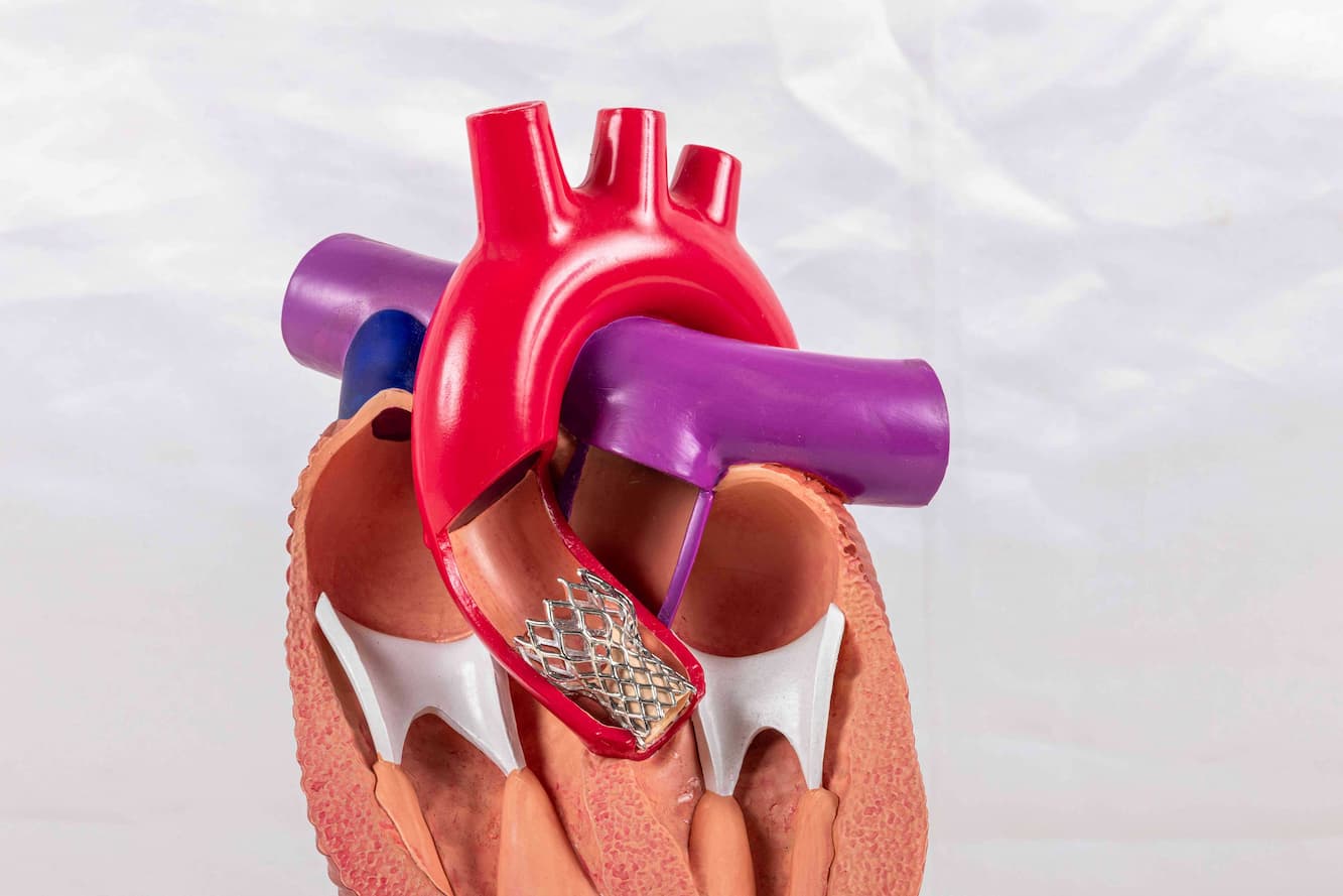 Transcatheter Aortic Valve Replacement TAVR