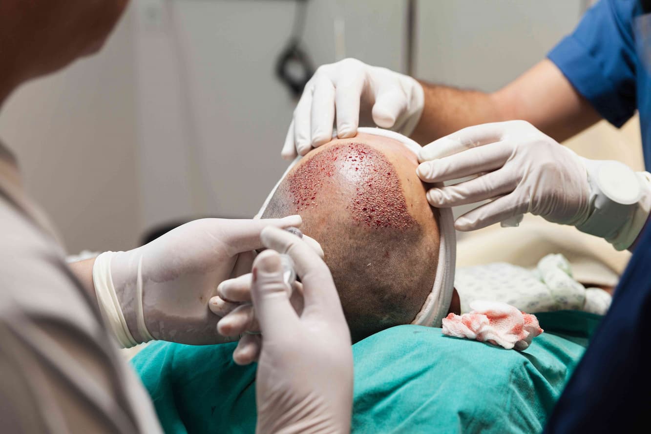 hair transplant