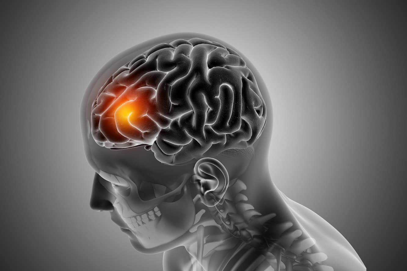 Arteriovenous Malformations (AVMs)