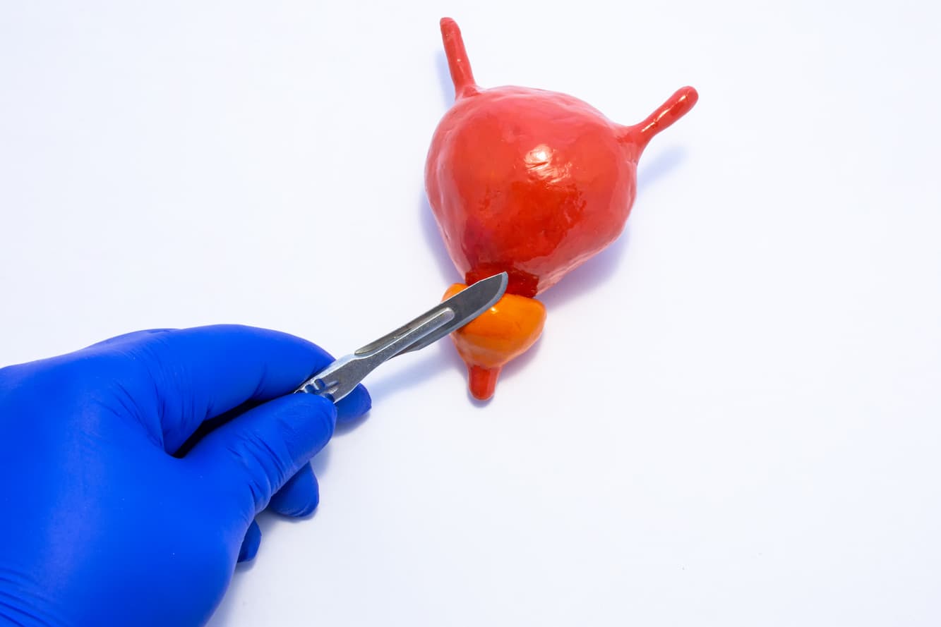 Prostatectomy